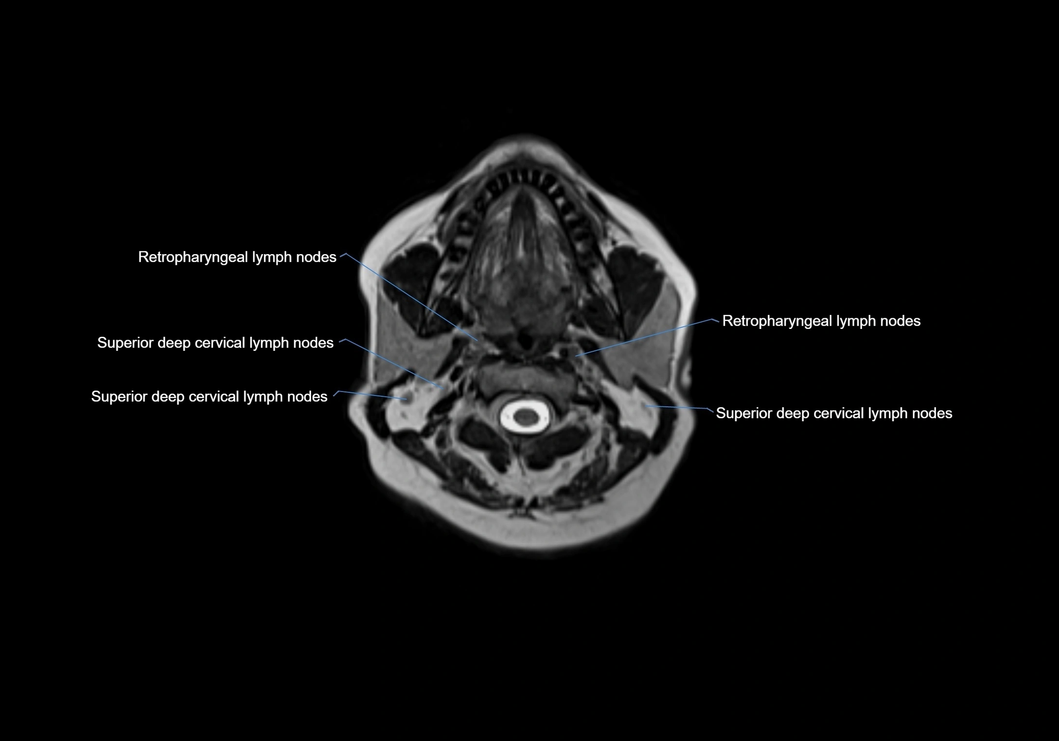 Neck axial  lymph node cross sectional MRI anatomy 3T MRI  image-img-00001-00040.webp